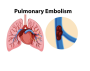 PumonaryEmbolism